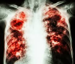 Tuberculosis: A Global Health Problem
